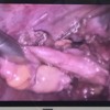 Pic 3 surgery 28 09 21: Common bile duct